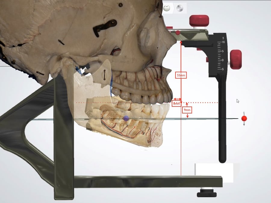 Proper Adjustment of an Anterior Smile Case with the 3Shape Virtual